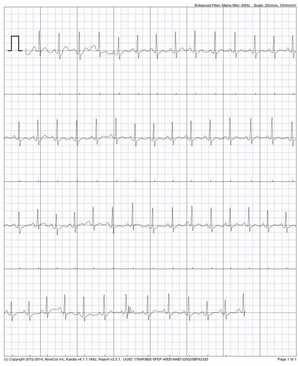 KardiaMobile 1-Lead EKG Monitor, Medical-Grade FDA-Cleared Personal Heart Monitor, Detects Normal, AFib & Arrhythmias, 30 Second Results, Works with Smartphones, Pocket Size, No Subscription Required customer photo 1