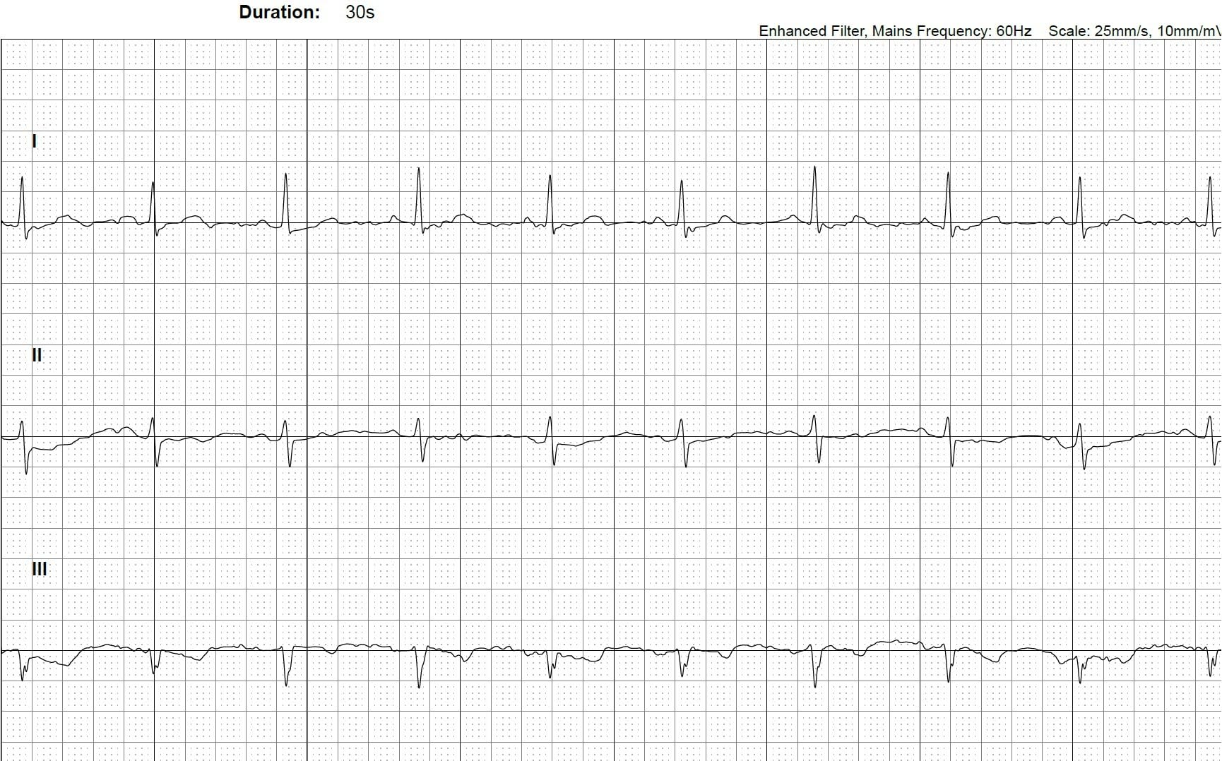 KardiaMobile 6-Lead Personal EKG Monitor - Six Views of The Heart - Detects AFib and Irregular Arrhythmias - Instant Results in 30 Seconds - Works with Most Smartphones - FSA/HSA Eligible customer photo 1